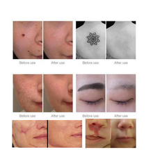 Load image into Gallery viewer, Home Laser Removal Pen for Tattoos Moles & Blemishes